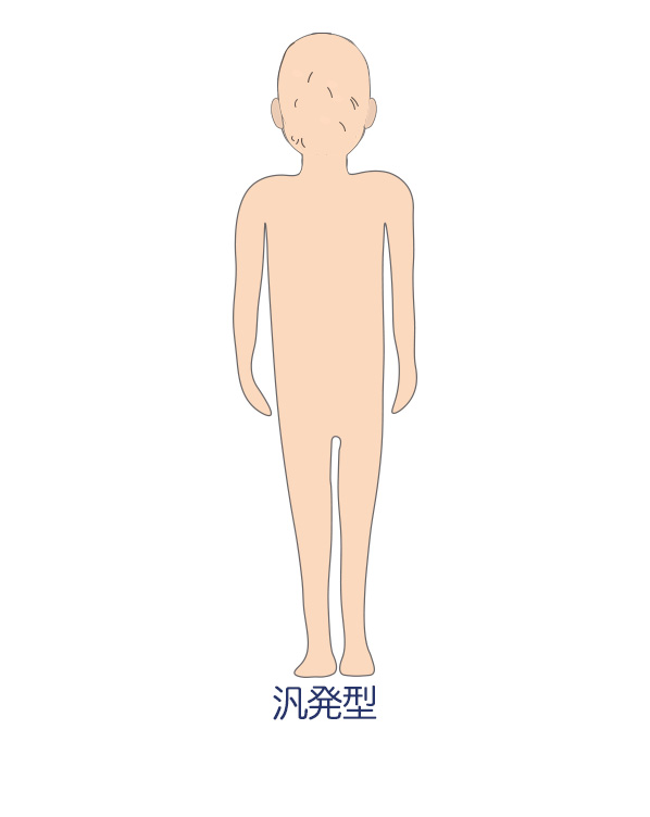 円形脱毛症_汎発型